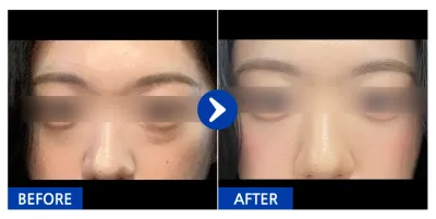 [江南姐姐] 眼底脂肪重新配置 / 1個月 / 暱稱：淡淡的橘子