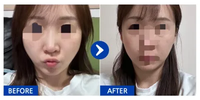 [江南姐姐] 顴骨 / 1個月 / 暱稱：Jjini