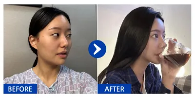 [Babitalk] 鼻整形、輪廓3項（顴骨、下顎角、下巴）/ 第3個月 / 暱稱：朴天天