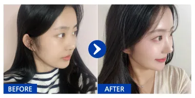 [Babitalk] 鼻整形、額頭脂肪移植 / 第2週 / 暱稱：냥냥냥웅웅