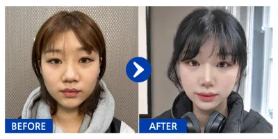 [Babitalk] 隆鼻 / 1個月 / 暱稱：나나나나나난니