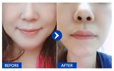 [江南姐姐 心得] 迷你拉皮 / 第1個月 / 暱稱：弘大魔女