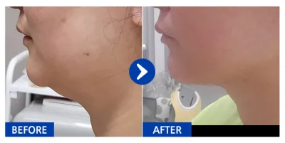 [江南姐姐] 抽脂 / 第1次 / 暱稱：書俊愛媽