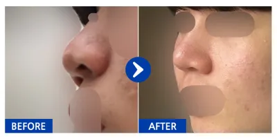 [江南姐姐] 鼻子 / 滿1個月 / 暱稱：李佳溫12