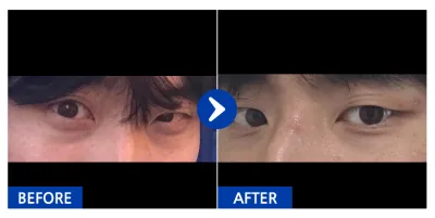 [江南姐姐] 眼底脂肪重新配置 / 第3個月 / 暱稱：辛方白先生