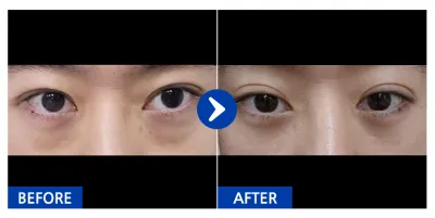 [Babitalk] 眼底脂肪重置 / 1個月 / 暱稱：냥이KdOcl