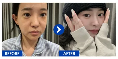 [江南姐姐] 鼻部修復手術 / 第2個月 / 暱稱：海路益巴