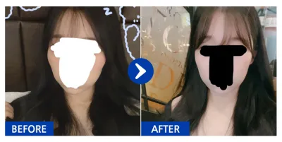 [江南姐姐] 顴骨術後3個月 / 暱稱：都是大小眼的錯;