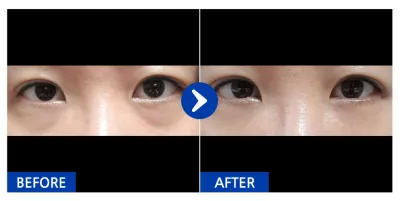 [江南姐姐] 眼底脂肪重新配置 / 第1個月 / 暱稱：是我呀