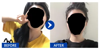 [江南姐姐] 顴骨、下顎角 第1個月 / 暱稱：아러라라라라랑