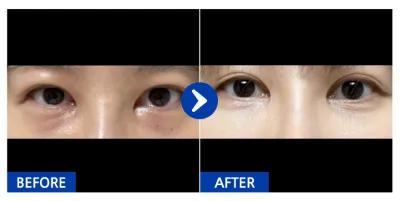 [江南姐姐] 眼底脂肪重新排列 / 1個月 / 暱稱：anjjjjjjj