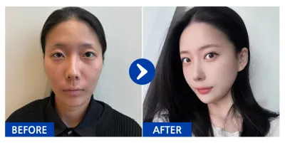 [Babytalk] 輪廓三項、眼型矯正、切開法雙眼皮、眼底脂肪重新配置、脂肪移植（臉頰、額頭） / 術後1個月 / 暱稱：갱쥐Y8tvn