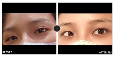 [江南姐姐 心得] 眼部整形滿一個月 / 暱稱：疲憊的犰狳