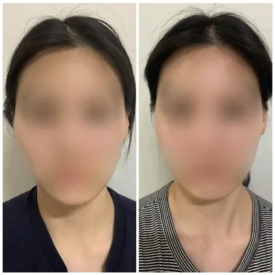 [江南姐姐 心得] 輪廓整形滿一個月 / 暱稱：多比美拉