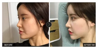 [江南姐姐評價] 隆鼻滿一個月 / 暱稱：2233332222