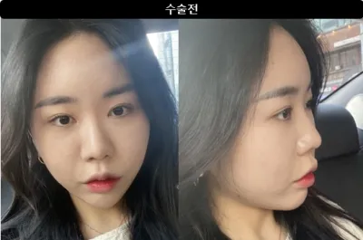 [江南姐姐評價] 隆鼻第1個月 / 暱稱：得勒勒勒得勒勒