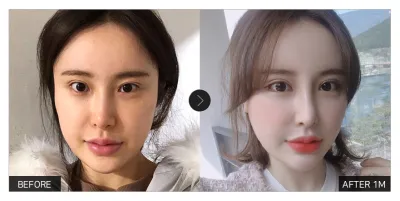 [江南姐姐評價] 眼部整形滿一個月 / 暱稱：2233332222