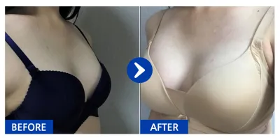 [江南姐姐] 隆乳 (賽彬) / 2個月 / 暱稱：정쓔기