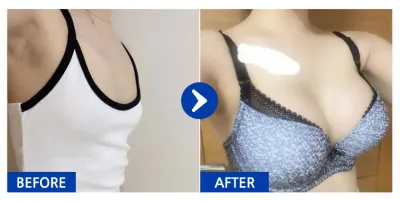 [江南姐姐] 隆乳(曼陀) / 第4個月 / 暱稱：噗哈哈