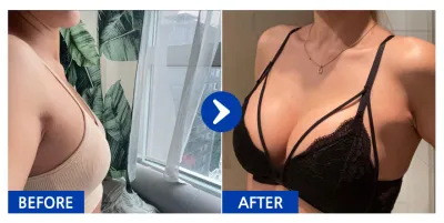 [江南姐姐] 隆乳(魔滴) / 第5個月 / 暱稱:Regina0