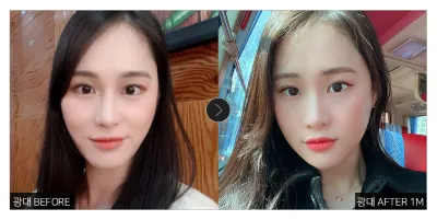 [江南姐姐評價] 顴骨縮小術滿一個月 / 暱稱：希尼瑪尼姆