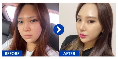 [江南姐姐] 隆鼻 / 第5個月 / 暱稱：黑珍珠