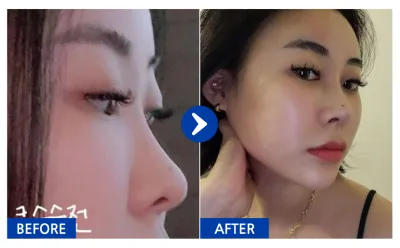 [Babitalk] 隆鼻 / 術後2個月 / 暱稱：꽃슈니이