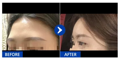 [江南姐姐] 脂肪移植 / 第2個月 / 暱稱：영ㅇ0