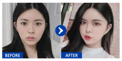 [Babytalk] 脂肪移植、臉部輪廓、雙眼皮 / 第3個月 / 暱稱：우아어아아아