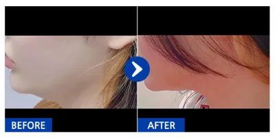 [江南姐姐] 抽脂 / 暱稱：BYJ72