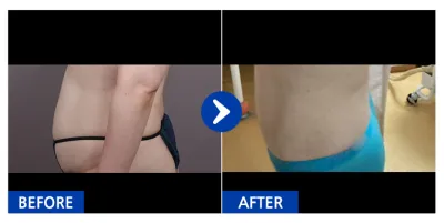 [Babitalk] 抽脂 / 第1個月 / 暱稱：如花般的他