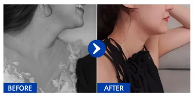 [Babitalk] 抽脂 / 第2個月 / 暱稱：丹妮啾啾