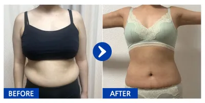 [Babitalk] 腹部、手臂抽脂 / 第5個月 / 暱稱：別吃那是你熟悉的味道