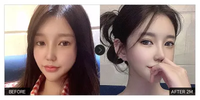 [江南姐姐 心得] 提肌矯正、眼睛重修滿一個月 / 暱稱：wingit