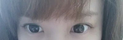 [眼睛] Moviestar7 - 後眼角切開, 下眼瞼下至