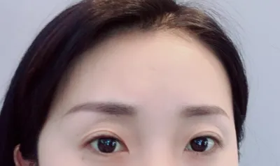 [眼睛] 金正 金點 - 開後眼角、開下眼角