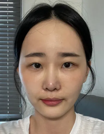 [眼部] 小小 - 埋線雙眼皮、開眼頭、開眼尾