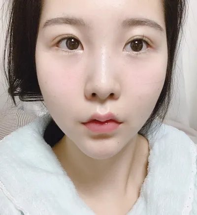 [眼睛] 冬季 - 切開雙眼皮（重修手術），開眼頭（重修手術），開眼尾