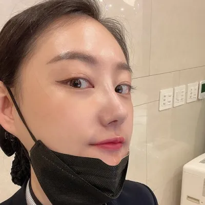 [鼻] 銀河水 - 鼻樑鼻尖截骨駝峰鼻