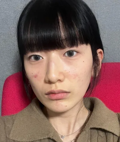 [眼睛] 이슬 - 非切開眼瞼下垂矯正