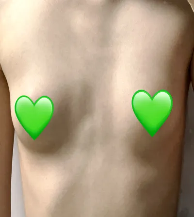 [隆胸] 消滅蚊子 - 胸部