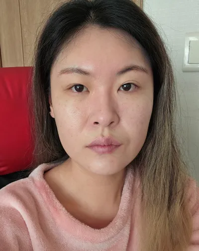 [眼部] 초로기 - 埋線雙眼皮、開後眼角、開下眼角