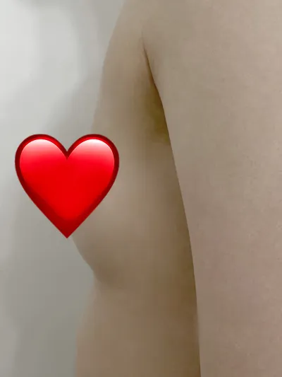 [隆胸] Nana - 隆胸