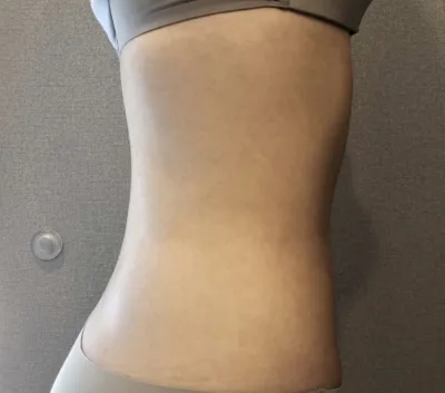 [抽脂] 如星星般飛舞 - 腹部、小腿抽脂