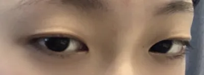 [眼部] kkmmgg52 - 雙眼皮（埋線）