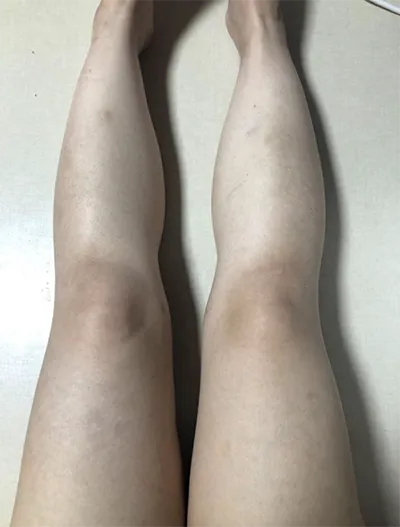 [抽脂] zz0808 - 抽脂