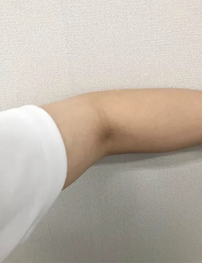 [微整形] 炎熱的天氣 - 手臂