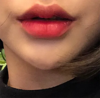 [微整形] ddd97 - 填充劑、肉毒桿菌