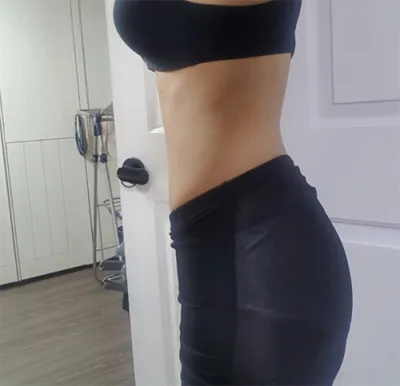 [抽脂] 喬雅登 - 抽脂(腹部)