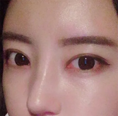 [鼻] tatun12 - 鼻子、眼睛、脂肪移植